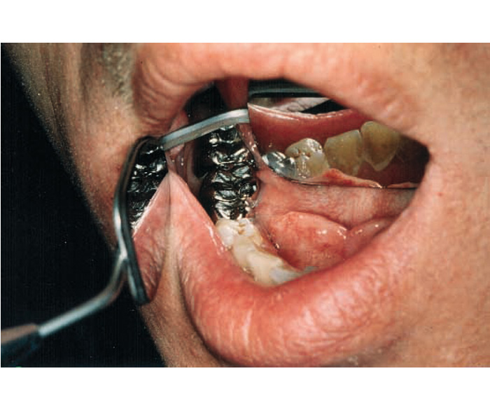 TONGUE PROTECTOR WITH MIRROR