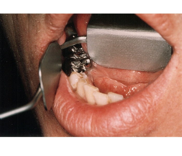 PAIRE OF TONGUE PROTECTOR