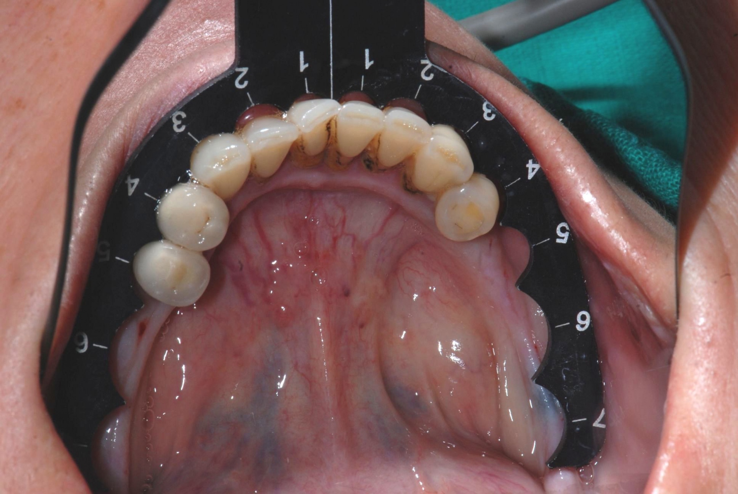 UNIVERSAL IMPLANT GUIDE
